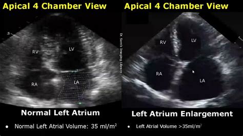 how to read echocardiogram|echocardiogram normal and abnormal findings.